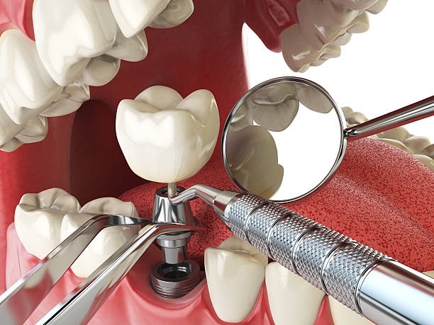 Best Emergency Root Canal Treatment in Ross, CA